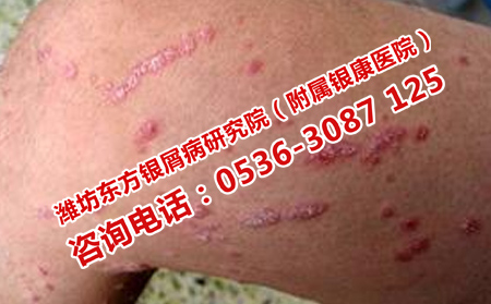 治療銀屑病治療效果理想的醫(yī)院