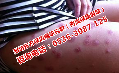 濰坊治牛皮癬的皮膚病醫(yī)院