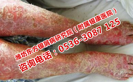 怎樣擺脫牛皮癬復(fù)發(fā)