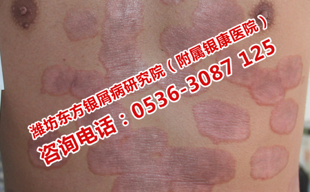 牛皮癬診療的流程是什么