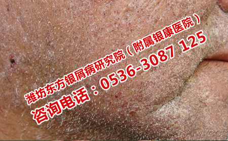 預(yù)防牛皮癬的秋季復(fù)發(fā)