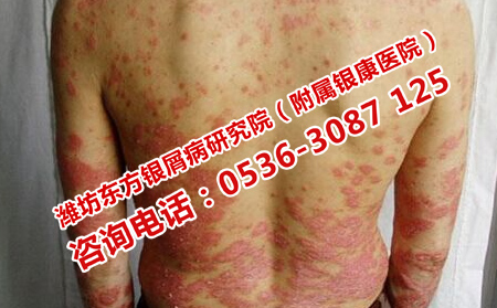 濰坊首先選擇的牛皮癬醫(yī)院