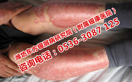 濰坊哪家醫(yī)院看銀屑病理想