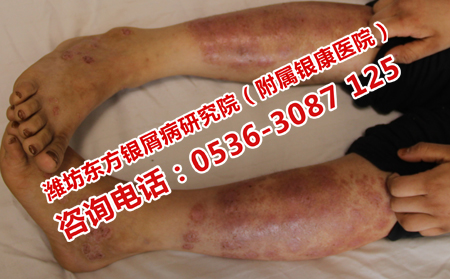 牛皮癬總是治不理想是為什么