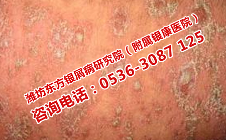 青州治牛皮癬的專業(yè)療法