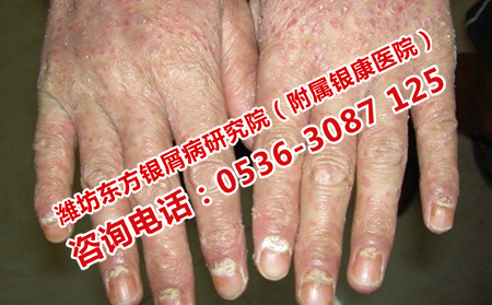 寒亭銀屑病去哪里治理想