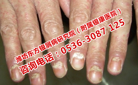 青州有效銀屑病方法