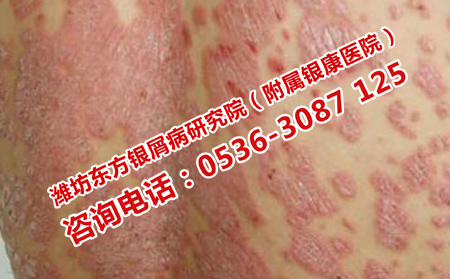 濰坊治療銀屑病的專科醫(yī)院