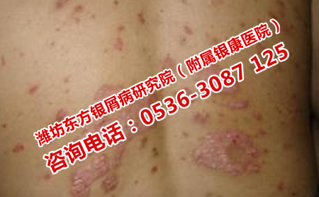 濰坊治療牛皮癬價(jià)格