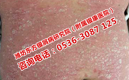 高密理想點的牛皮癬醫(yī)院