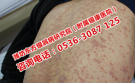 世界銀屑病日常識