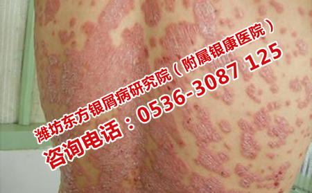 濰坊看牛皮癬理想的醫(yī)院