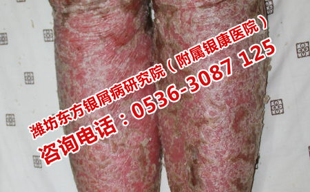 專門治牛皮癬的醫(yī)院