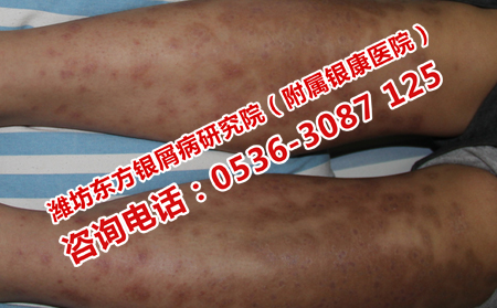 濰坊治銀屑病的費(fèi)用