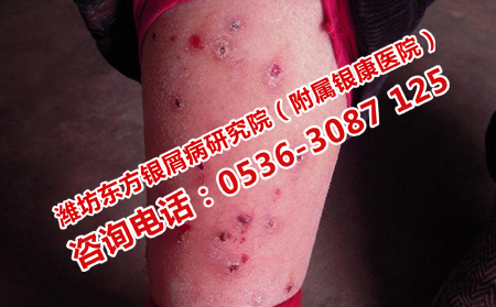 治療銀屑病的洗劑