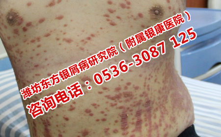 盡量去那家醫(yī)院治牛皮癬