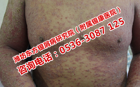 濰坊看銀屑病的專門醫(yī)院