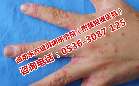 反復發(fā)作的銀屑病去哪里治