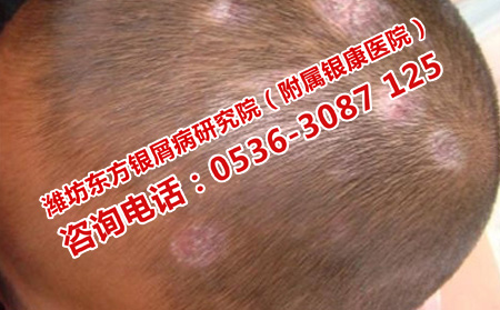 濰坊比較理想的銀屑病醫(yī)院