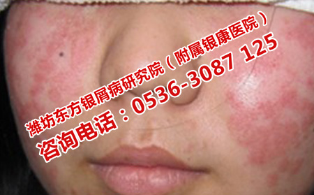 兒童銀屑病醫(yī)院濰坊