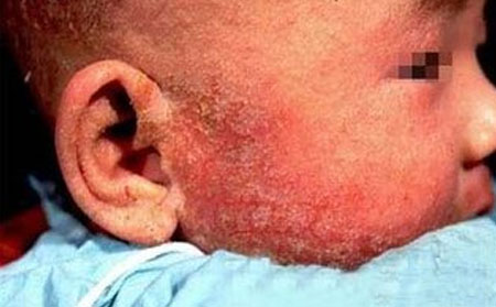 銀屑病復(fù)發(fā)的四大誘因