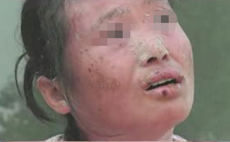 濰坊牛皮癬醫(yī)院治療效果理想嗎