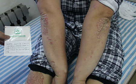 治療銀屑病實(shí)力強(qiáng)的醫(yī)院