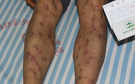 規(guī)范治療實現(xiàn)銀屑病的恢復