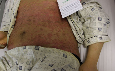 如何加快銀屑病的恢復(fù)