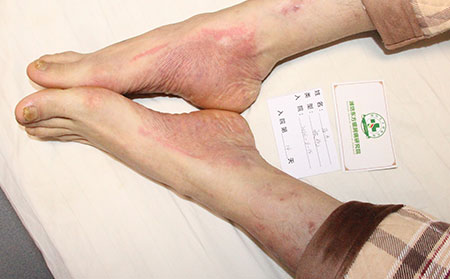 銀屑病哪里能治理想