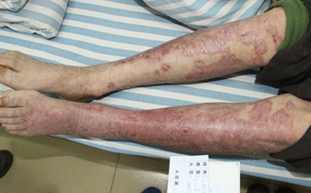 銀屑病治療正規(guī)醫(yī)院