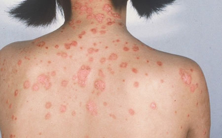 銀屑病恢復(fù)了還遺傳嗎