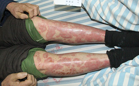 為何發(fā)生重癥銀屑病