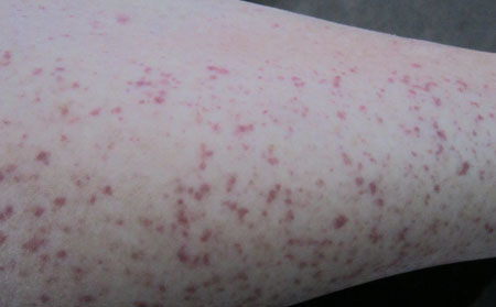 兒童過(guò)敏性紫癜