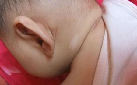 兒童白癜風(fēng)常識,白癜風(fēng)長在什么部位