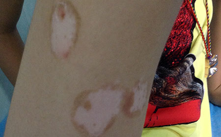 中醫(yī)治療白癜風(fēng)是怎么治的