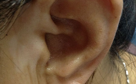 阻礙白癜風(fēng)痊愈的原因有哪些