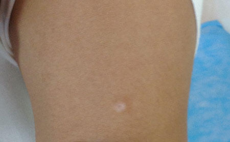 治療白癜風(fēng)