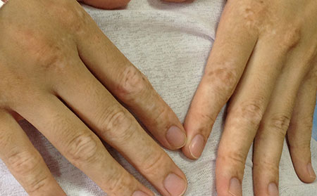 治療白癜風(fēng)要注意什么問題