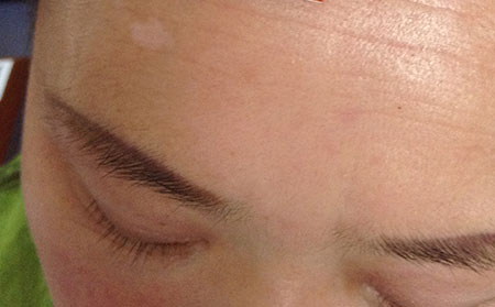 治療白癜風(fēng)要注意什么