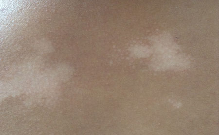 治療白癜風(fēng)要怎么選擇好的醫(yī)院