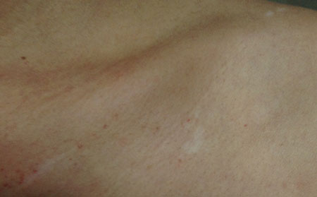 治療白癜風(fēng)需要多長(zhǎng)時(shí)間