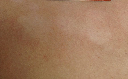 治療白癜風(fēng)需要多長(zhǎng)的時(shí)間