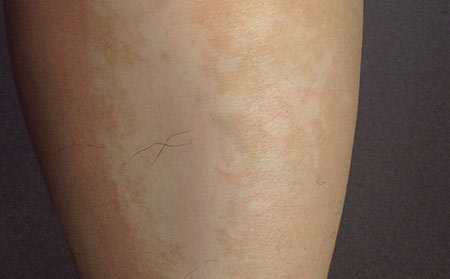 治療白癜風(fēng)生活上需要注意什么