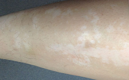 治療白癜風(fēng)患兒應(yīng)繞開(kāi)的誤區(qū)