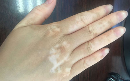 治療白癜風(fēng),治療白癜風(fēng)好方法,中醫(yī)治療白癜風(fēng)