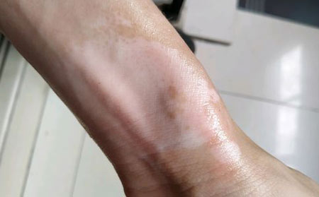 治療白癜風(fēng),治療白癜風(fēng)的方法,中醫(yī)治療白癜風(fēng)