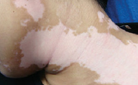 治白癜風(fēng)的中醫(yī)