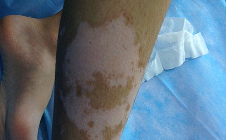 治療白癜風的誤區(qū)