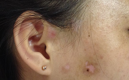 治療白癜風(fēng),白癜風(fēng)多久可以治好,治療白癜風(fēng)醫(yī)院